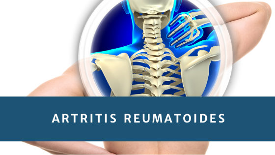 Remedios caseros para la Artritis Reumatoide